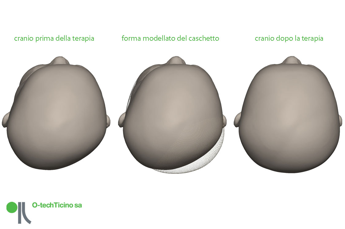 Caschetti correttivi Caschetti correttivi